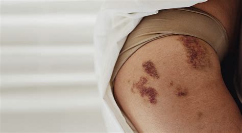 What Conditions Cause Bruising? | Healthnews