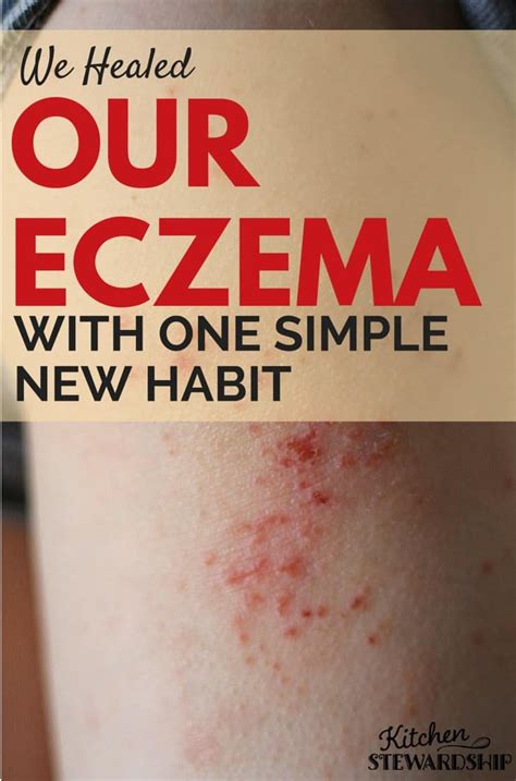 Stop the Itch - Identify Triggers and Treat Eczema Naturally! | Natural cure for eczema, Eczema ...