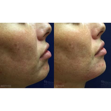 Medical Spa West LA & La Cañada Flintridge | Skin Specifics | chin reshaping with juvederm 8321