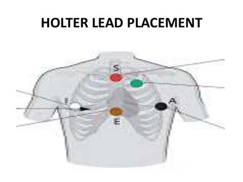 Holter Monitor Lead Placement Diagrams