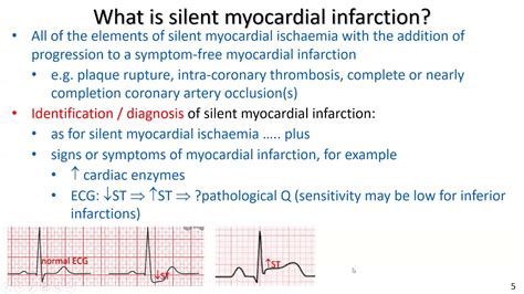 “Silent” myocardial ischaemia and “silent” myocardial infarction for exercise professionals ...