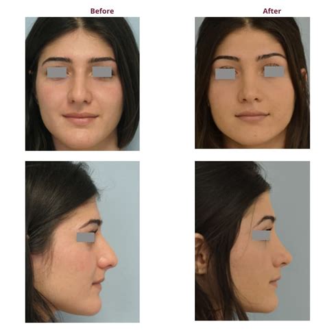 The Best Rhinoplasty Surgeons in Los Angeles - My Beauty Consultant