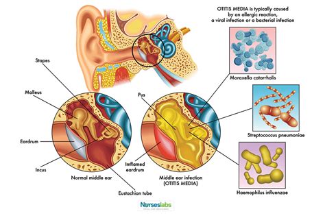 Otitis Media Nursing Care Planning and Management: Study Guide | Otitis media, Otitis, Nursing ...