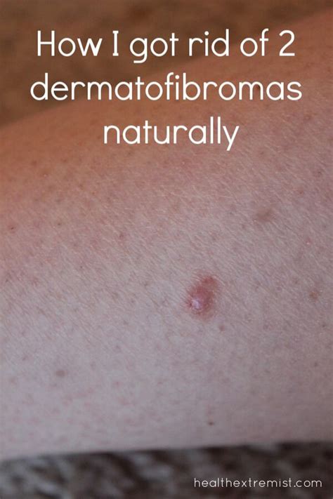 How to Get Rid of a Dermatofibroma Naturally