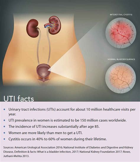 Diagnosis, treatment, and prevention of cystitis - American Nurse