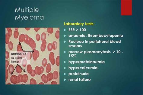 Multiple Myeloma Multiple Myeloma Definition B-cell malignancy