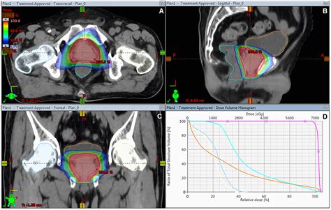 Hypofractionated versus conventionally fractionated image-guided volumetric-modulated arc ...