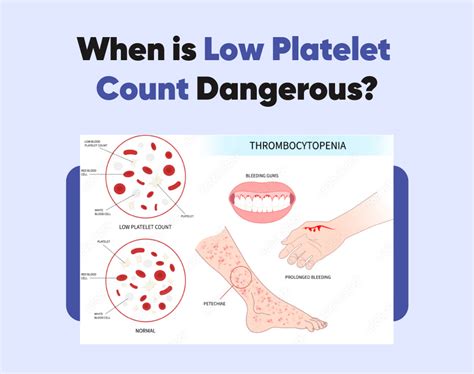 When is Low Platelet Count Dangerous?