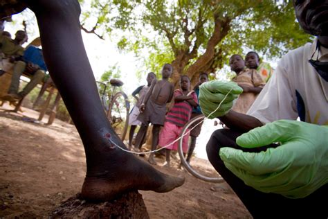 Guinea Worm Disease Could Soon Become The Second Human Disease To Be ...