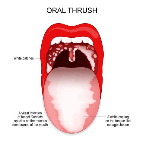 What Can Cause Your Tongue to Turn Green?