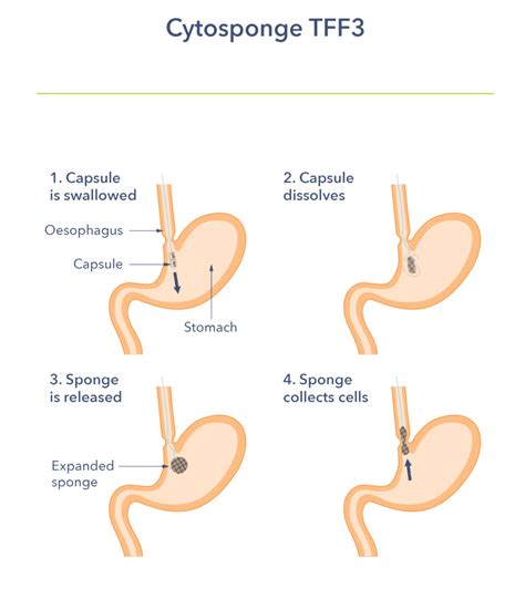 Barrett's Oesophagus - Guts UK