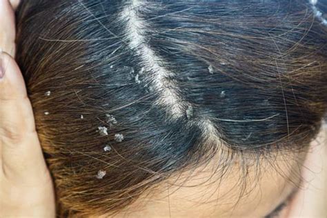 Here’s How To Tell The Difference Between Dandruff And Dry Scalp (And How To Treat Each In The ...