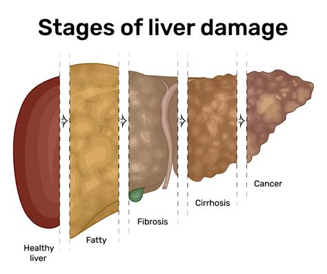 Liver Disease | Advocate Health Care