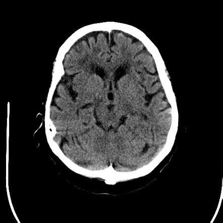 Loss of insular ribbon sign | Radiology Case | Radiopaedia.org