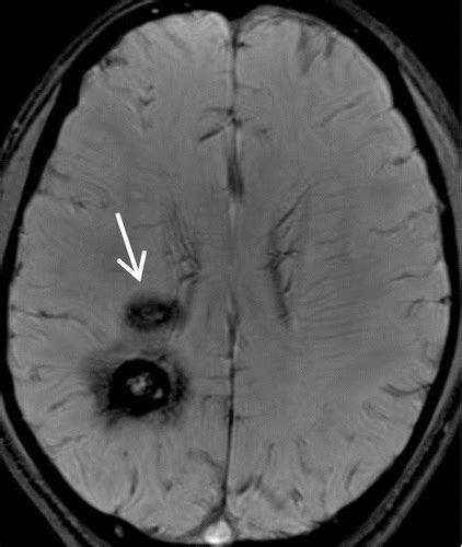 Intracranial Calcifications and Hemorrhages: Characterization with Quantitative Susceptibility ...