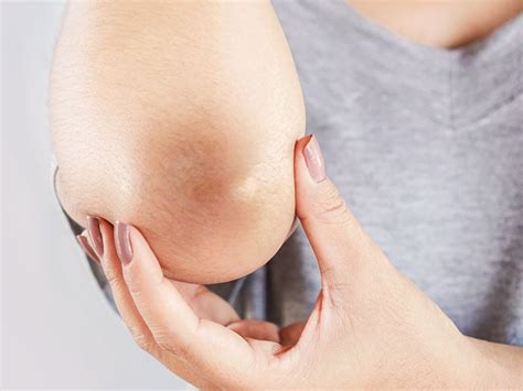 How Do You Get Rid Of Calluses On Your Elbows Effectively?