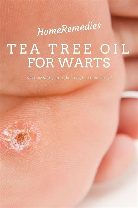 How to Remove Warts using Tea Tree Oil | Tea tree oil warts, Tea tree ...