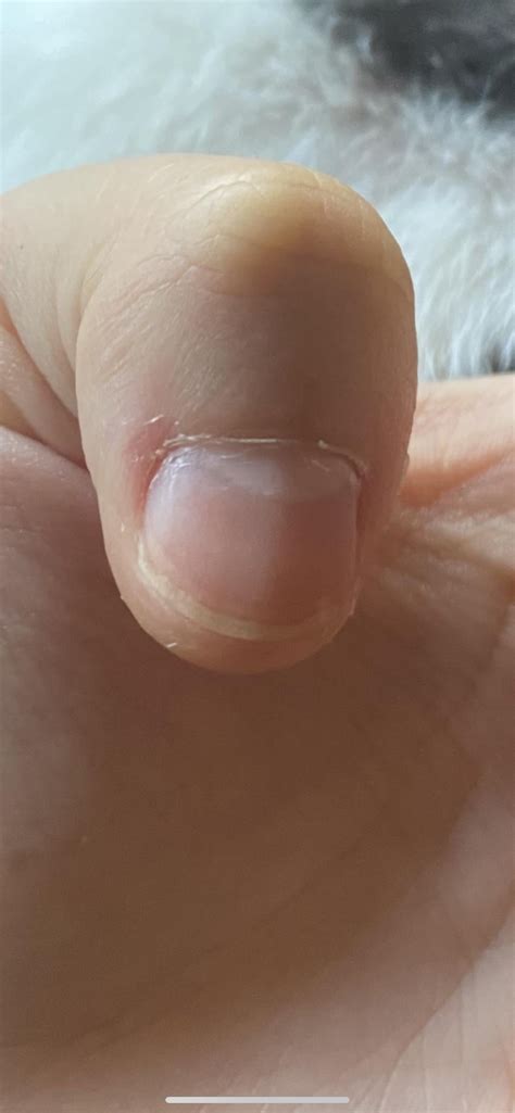 Nail bed growth : r/calmhands