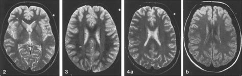 a-d Watershed areas in the brain Fig.2. Lower signal intensities in the... | Download Scientific ...