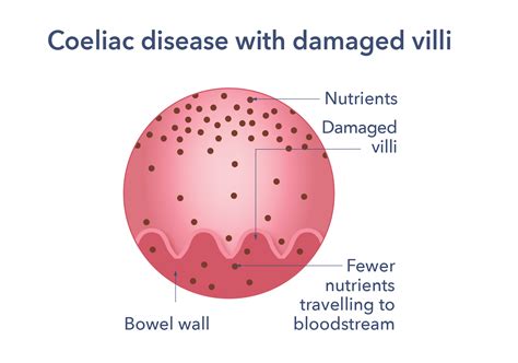 Coeliac Disease | Causes, Symptoms, Treatment & Support | Guts UK