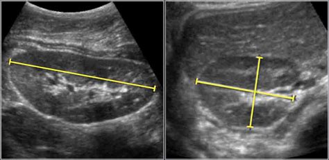 What do the colors on a kidney ultrasound mean – The Meaning Of Color