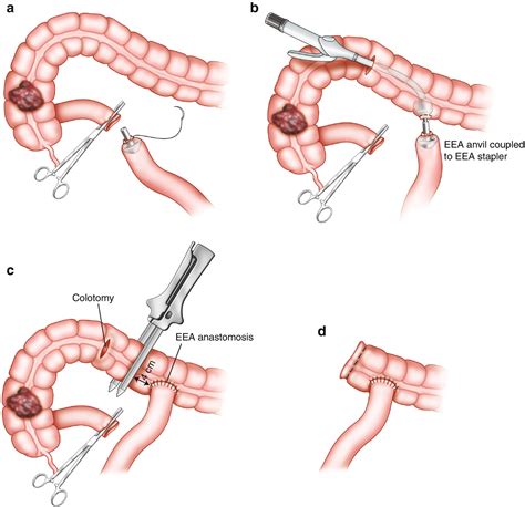 Anastomotic Construction | SpringerLink