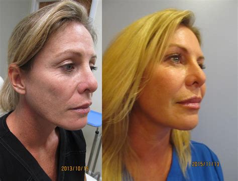 Smart Lipo in Boca Raton | Laser-Assisted Liposuction, Minimally Invasive