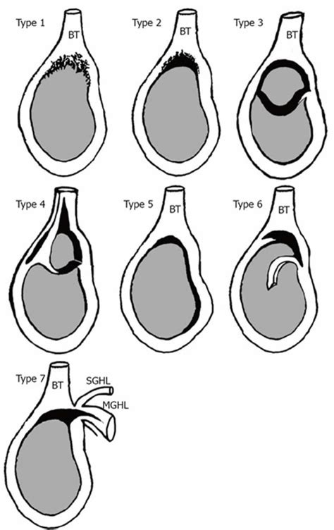 Labrum cartilage tear shoulder, causes, symptoms, diagnosis & treatment