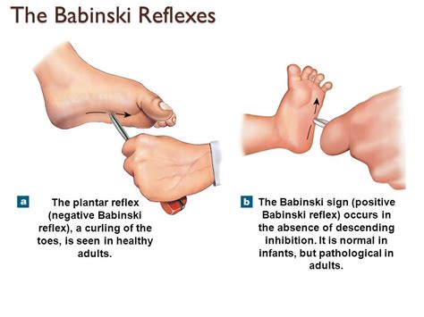 The Babinski reflex is normal in infants but abnormal in adults. Normal ...