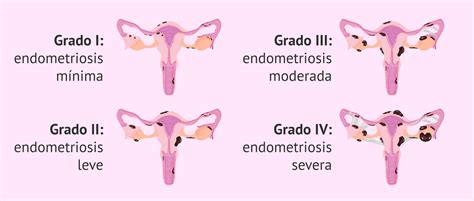 ¿Cuáles son los grados de endometriosis?