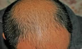 Online Media: Severe Dandruff Treatment