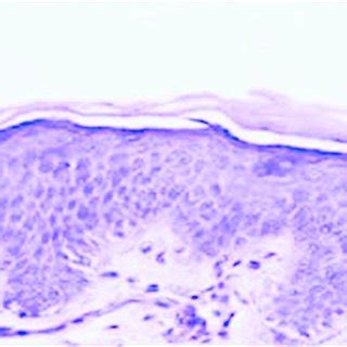 (PDF) Familial acral peeling skin syndrome with palmoplantar keratoderma