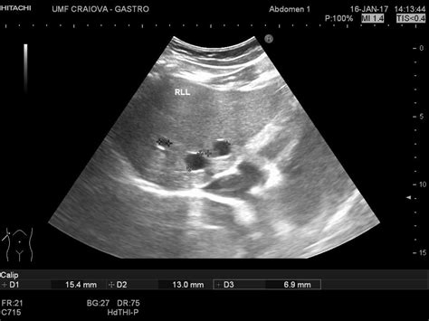 Liver cysts [2 images] – EFSUMB