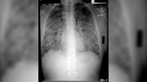 Blastomycosis Lung X Ray