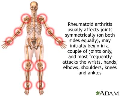 Rheumatoid arthritis Information | Mount Sinai - New York