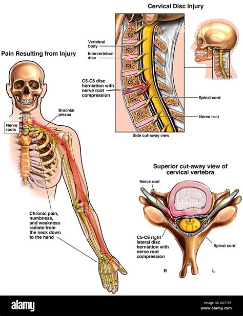 Cervical Disc Injury Stock Photo: 7710304 - Alamy