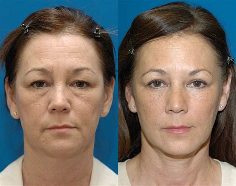 Eyelid Lift Seattle | Blepharoplasty Specialist | Cosmetic Eyelid Surgery