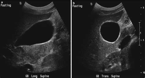 The Gallbladder | Radiology Key