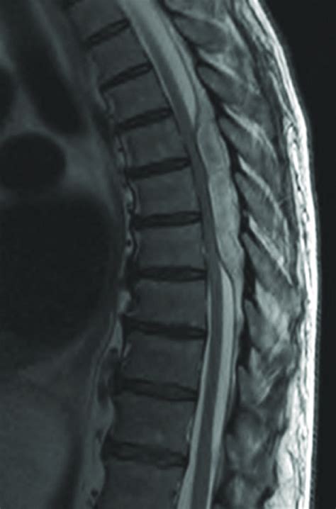 MRI documenting the epidural abscess. | Download Scientific Diagram