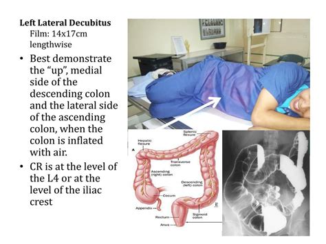 PPT - Radiographic Positioning for Barium Enema PowerPoint Presentation - ID:5995427