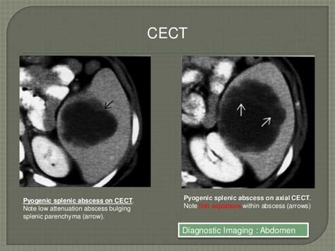 Spleen abcess - CT Findings