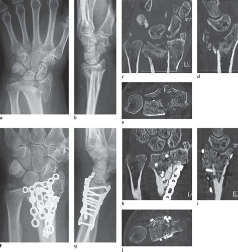 17 Trauma of the Distal Forearm | Radiology Key