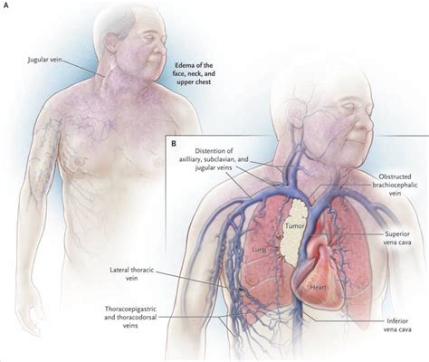 Bilbao, Superior Vena Cava Syndrome, Heart Disorders, Nursing Board, Jugular, Oncology Nursing ...