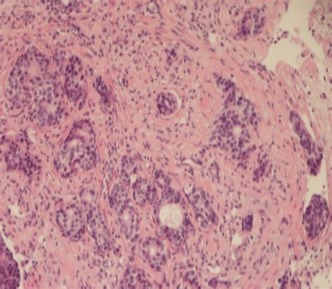 The left supraclavicular lymph node biopsy exhibited typical... | Download Scientific Diagram