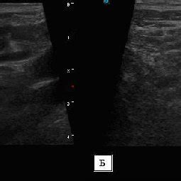 Comparison of the RD from McBurney's point to the base of the inflamed ...