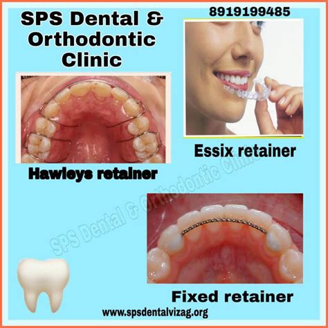 Retainers after braces treatment... ??SPS Dental & Orthodontic clinic-vizag