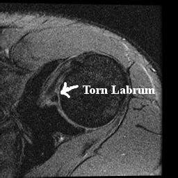 CT/MRI PATHOLOGY BLOG: SHOULDER PATHOLOGY-TORN LABRUM
