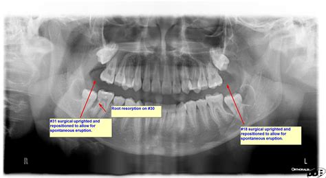 Panorex! Whats a panorex? Why do I need that? - Dr. Nima Massoomi DMD MEd MD