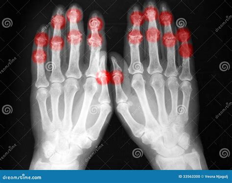 Plain Film X-ray, Radiography, Of Complete Foot In Two Projections ...