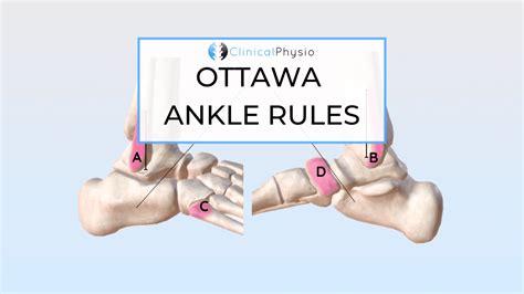 Ottawa Ankle Rules – Clinical Physio Membership